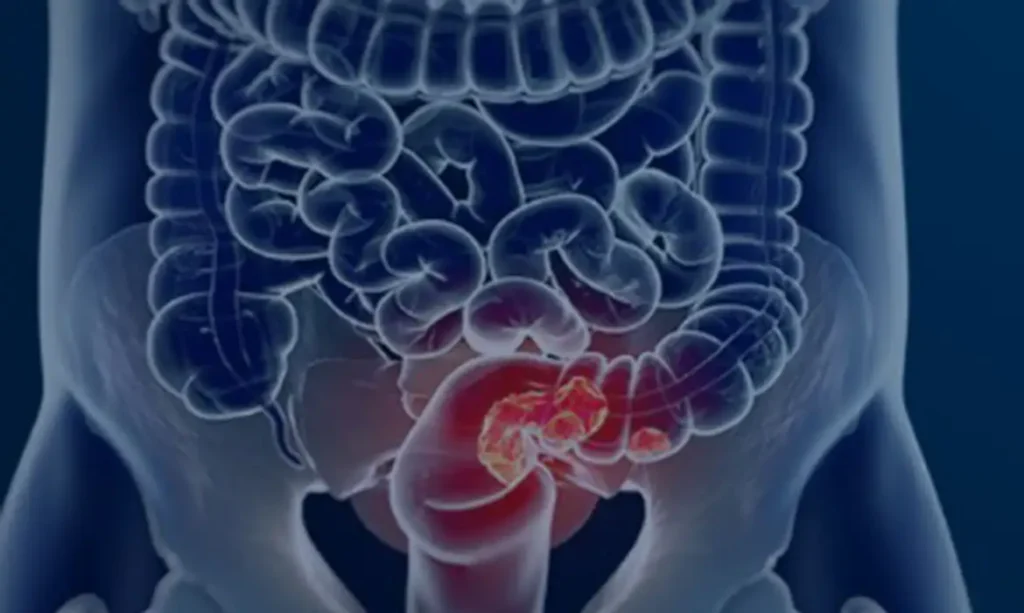 rastreamento câncer colorretal SUS