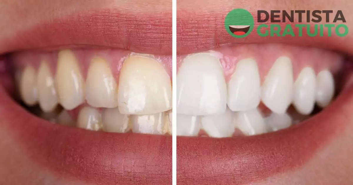 Mitos e Verdades sobre Clareamento Dental Caseiro