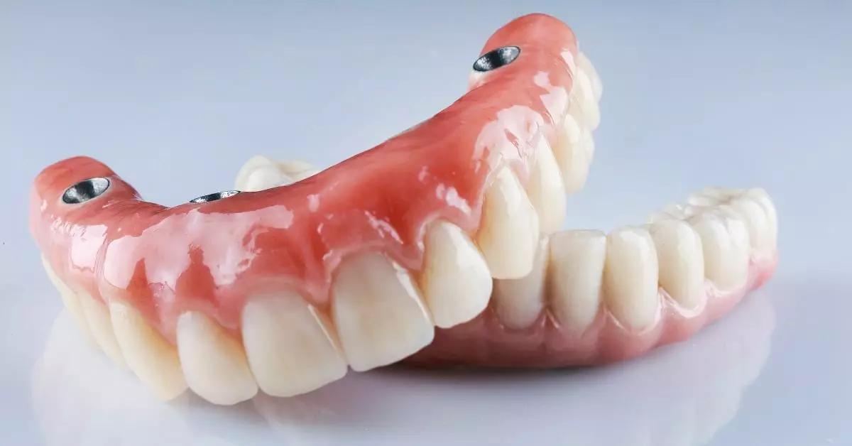 Implante dentário gratuito pelo Brasil Sorridente SUS